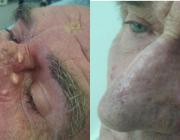 Множественные эпидермоидные кисты кожи носа до и после лазерной коагуляции.