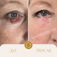 Лечение базальноклеточного рака кожи на веке Лечение базальноклеточного рака кожи на веке