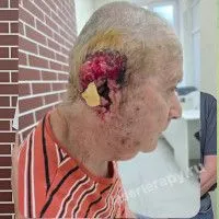 Пациента лечили по протоколу в онкодиспансере от плоскоклеточного рака. Пациента лечили по протоколу в онкодиспансере от плоскоклеточного рака.