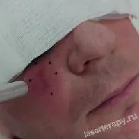 ФДТ при базалиоме — это лучшее решение на сегодняшний день! ФДТ при базалиоме — это лучшее решение на сегодняшний день!