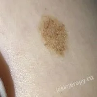 Меланоцитарные невусы на открытых участках тела Меланоцитарные невусы на открытых участках тела