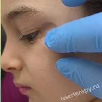 Удаление меланоцитарных невусов сложной локализации Удаление меланоцитарных невусов сложной локализации
