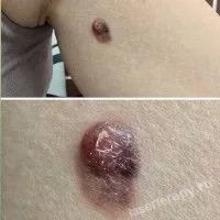 Меланома на коже плеча Меланома на коже плеча