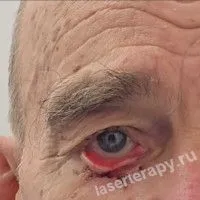 Базалиома века: классическая хирургия здесь часто бессильна. Базалиома века: классическая хирургия здесь часто бессильна.