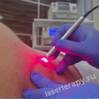 Лечение узловой меланомы - сложная задача. Лечение узловой меланомы - сложная задача.