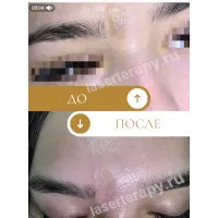 ФДТ меланоцитарных невусов ФДТ меланоцитарных невусов