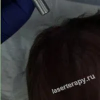 В Клинике ФДТ проводится удаление гигантских невусов, а также лечение рака кожи, базалиомы, первичной меланомы кожи, дисплазии шейки матки. В Клинике ФДТ проводится удаление гигантских невусов, а также лечение рака кожи, базалиомы, первичной меланомы кожи, дисплазии шейки матки.