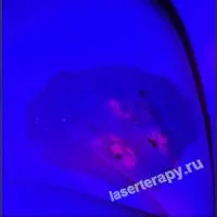 Фотодинамическая терапия по методике Павла Борисовича Попова - надежный и безопасный способ избавиться от врожденных меланоцитарных невусов любой площади и локализации. Фотодинамическая терапия по методике Павла Борисовича Попова - надежный и безопасный способ избавиться от врожденных меланоцитарных невусов любой площади и локализации.