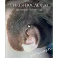 Рубцы после ФДТ Рубцы после ФДТ