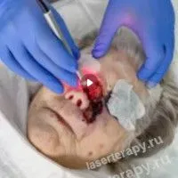 Пациенты с местнораспостраненным плоскоклеточным раком кожи лица Пациенты с местнораспостраненным плоскоклеточным раком кожи лица