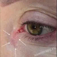 Лечение базалиомы медиального угла глаза с помощью фотодинамической терапии Лечение базалиомы медиального угла глаза с помощью фотодинамической терапии