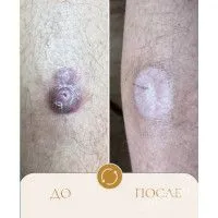 Базалиома голени. Базалиома голени.
